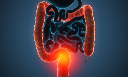 Role of Retinoic Acid Deficiency in Bowel Cancer Development Explored