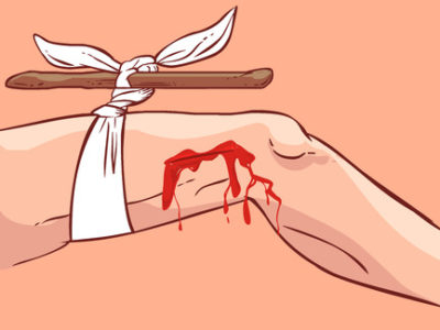 Researchers Trial Nerve Stimulation to Control Bleeding