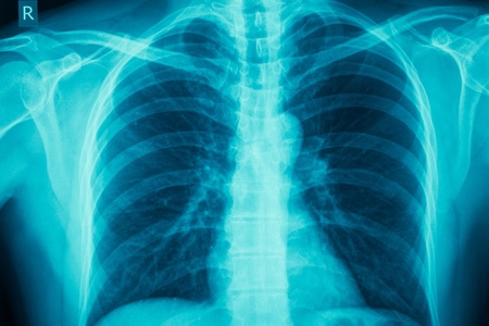 Lung Cells Grown from Stem Cells Could Potentially be Used as COPD and IPF Treatment