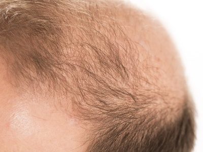 Stem Cell Treatment of Baldness Shows Promise