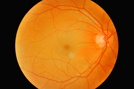 RNAi Used to Treat Ocular Inflammation