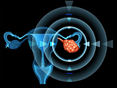 Experimental Treatment for Ovarian Cancer Shows Great Promise