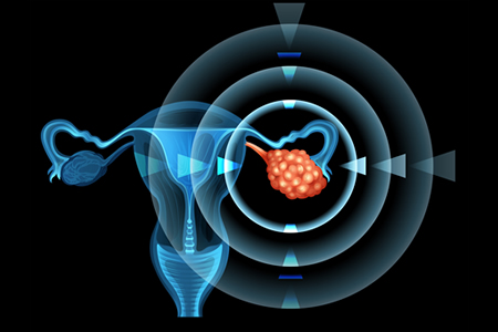 Experimental Treatment for Ovarian Cancer Shows Great Promise