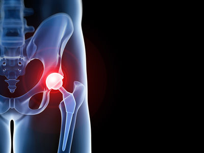 New Coating for Artificial Joints Simplifies Treatment of Prosthetic Joint Infections