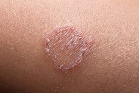 NO-Releasing Nanoparticles Viable Treatment for Deep Fungal Infections of the Skin