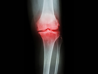 ‘Living Bandage’ Stem Cell Therapy for Knee Injuries Could Revolutionize Treatment of Meniscal Tears