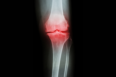 ‘Living Bandage’ Stem Cell Therapy for Knee Injuries Could Revolutionize Treatment of Meniscal Tears