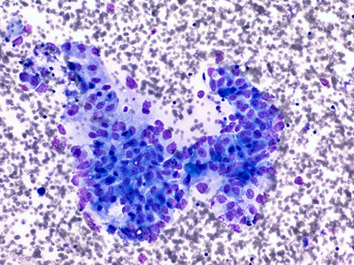 Tumors Discovered to Have Two Levels of Protection Against the Immune System