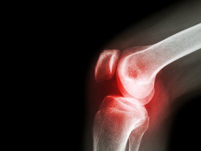 Cause of Rheumatoid Arthritis Discovered
