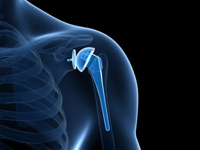 Bone Growth Increased by 45% Using Turmeric-Based Coated 3D Printed Scaffolds