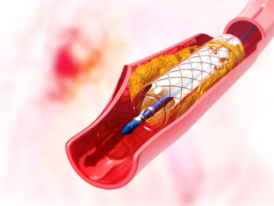 Advances Made in the Generation of Functional Arteries from Stem Cells