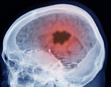 New MRI Technique Makes Brain Tumors Twice as Easy to Detect