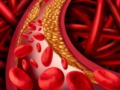 New Imaging Technique Accurately Identifies Cholesterol in Arterial Plaque