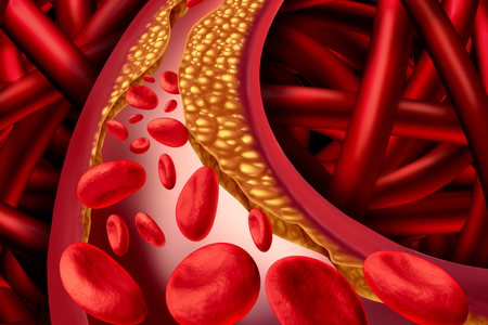 New Imaging Technique Accurately Identifies Cholesterol in Arterial Plaque