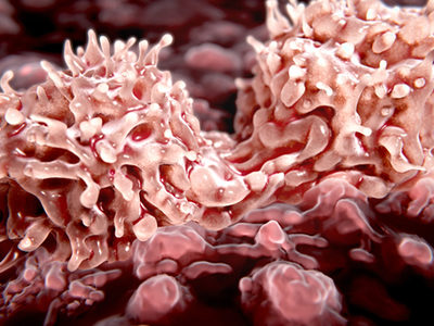 Researchers Develop Novel Non-Toxic Treatment for Cancers that Have Metastasized to Bone