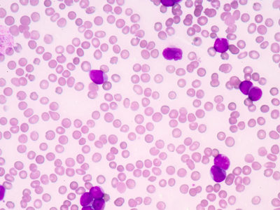 Researchers Move a Step Closer to Identifying Leukemic Stem Cells