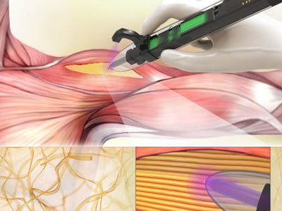 Handheld 3D Bioprinter Developed to Treat Volumetric Muscle Loss in Situ