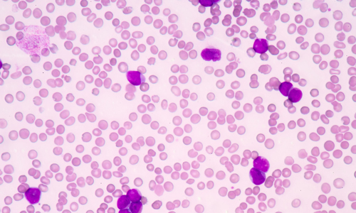 Researchers Discover Gene Essential to the Survival of AML Stem Cells