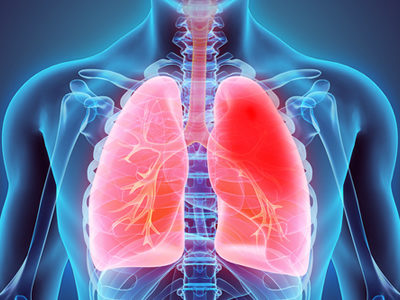 Novel RNA Sequencing Technique Provides Insights into Tuberculosis Progression
