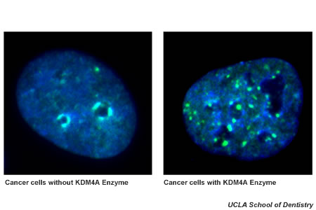 Inhibition of KDM4A Enzyme Slows Growth and Spread of Head and Neck Cancers