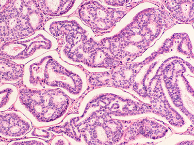 Cancer Metastasis Blocked in Mice with Low-Dose Drug Combination Therapy