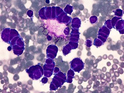 Fatty Aid in Palm Oil Increases Probability of Cancer Metastasis