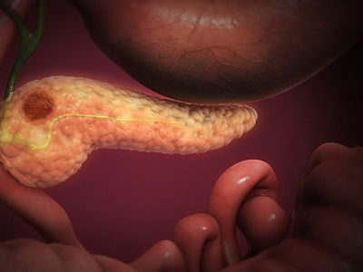 Fecal Microbiome Signature of Pancreatic Cancer Identified