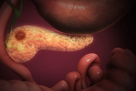 Fecal Microbiome Signature of Pancreatic Cancer Identified
